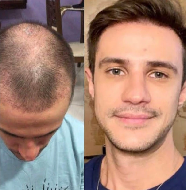 Foto de comparación antes y después de trasplante capilar, dos retratos de rostro lado a lado del mismo paciente con gafas, mostrando calvicie en la coronilla de un lado y cabello restaurado y denso del otro, fotografía clínica realista