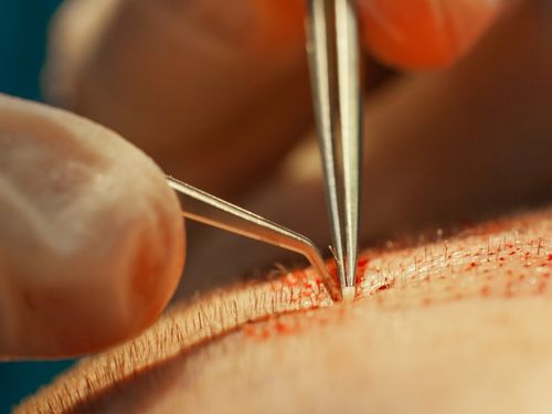 Primer plano de la técnica FUE de extracción folicular capilar, instrumento punch de precisión sobre el cuero cabelludo, detalle médico ultra realista