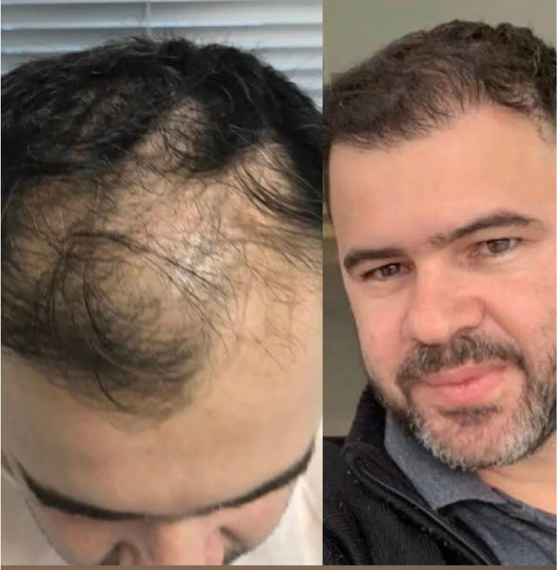 Foto de comparación antes y después de trasplante capilar, dos retratos de rostro lado a lado de paciente adulto sonriendo, mostrando entradas marcadas de un lado y línea frontal natural y densa del otro, fotografía clínica realista