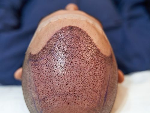 Fotografía médica mostrando implante capilar hilo a hilo, pinza implantadora posicionando folículo individual en el cuero cabelludo, alta precisión, luz clínica