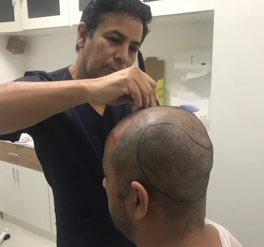 Fotografía de resultado de trasplante capilar masculino, paciente de perfil mostrando línea frontal densa y natural, ambiente clínico, iluminación suave, fotografía médica realista