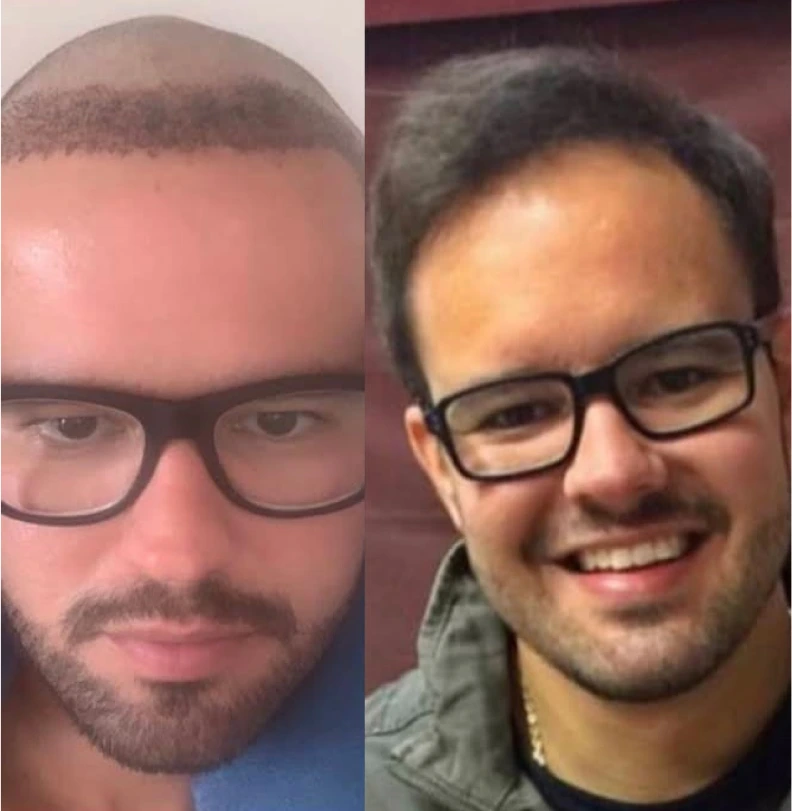 Foto de comparación antes y después de trasplante capilar, dos retratos de rostro lado a lado de paciente calvo en la parte superior de la cabeza y tras trasplante con cobertura completa, fotografía clínica realista