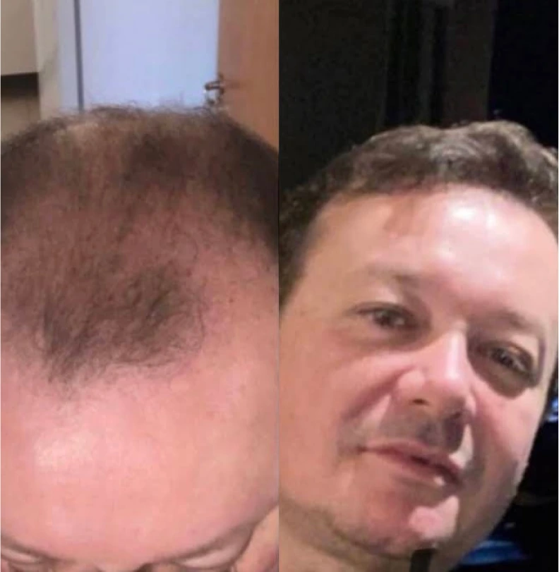Foto de comparación antes y después de trasplante capilar, dos retratos de rostro lado a lado del mismo paciente mostrando línea frontal retrocedida de un lado y cabello denso y natural del otro, fotografía clínica realista