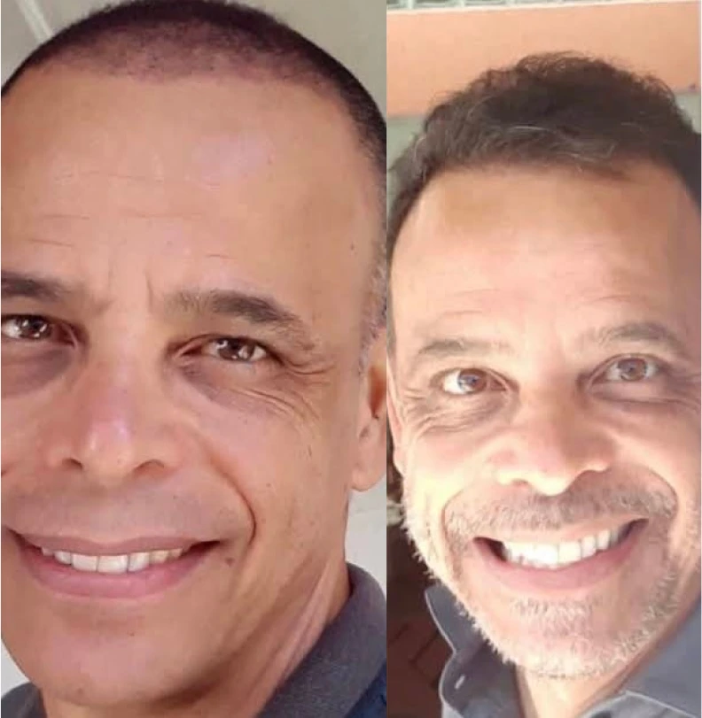 Foto de comparación antes y después de trasplante capilar, dos retratos de rostro lado a lado mostrando entradas temporales acentuadas de un lado y corrección natural del otro, fotografía clínica realista