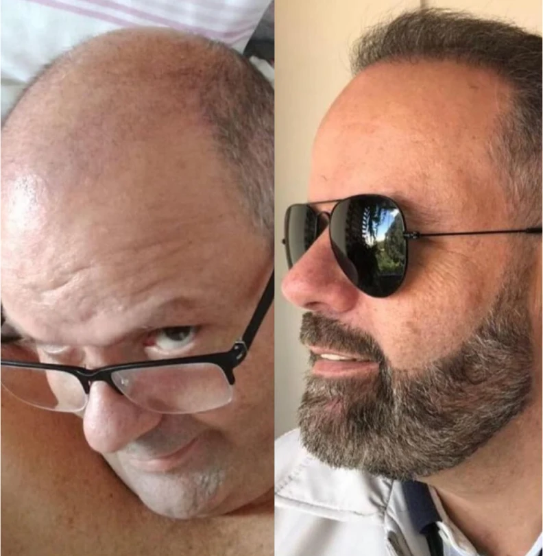 Foto de comparación antes y después de trasplante capilar, dos retratos de rostro lado a lado de paciente calvo usando gafas oscuras y después de densificación capilar completa, fotografía clínica realista